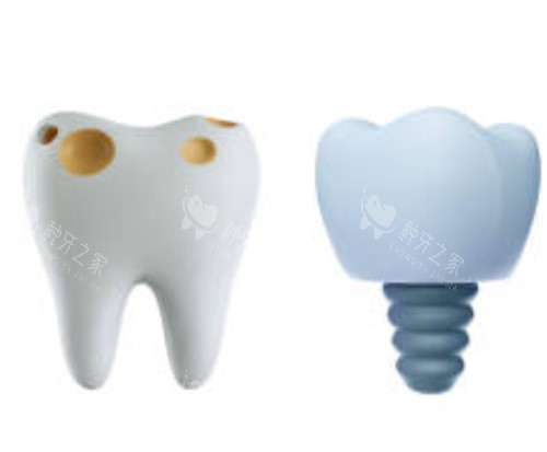 2026绍兴种植牙价格参考！集采后2980元起！