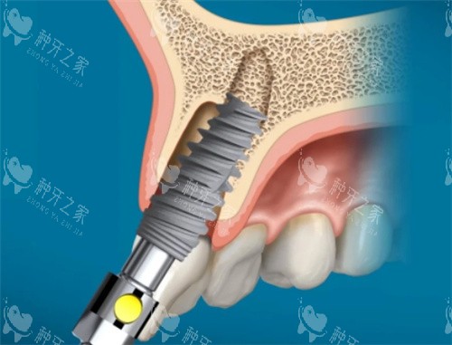 nobel active种植过程中可以改变方向