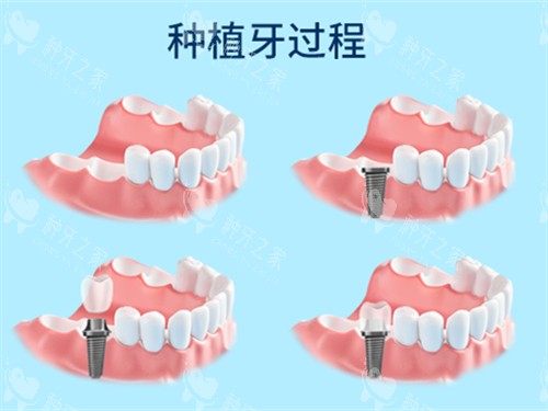 长春种牙哪里种的好又不贵？多家正规机构2880起