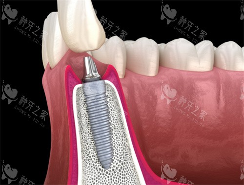 种植牙解剖图 种植牙解剖图