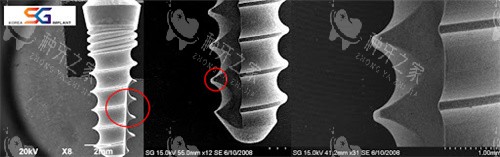 韩国SG种植体好吗?优缺点|价格|使用年限一文查询