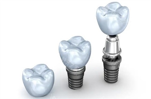 种植牙基台牙冠