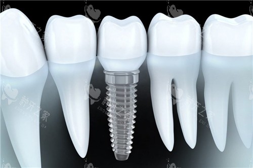 单颗种植牙图示 单颗种植牙图示