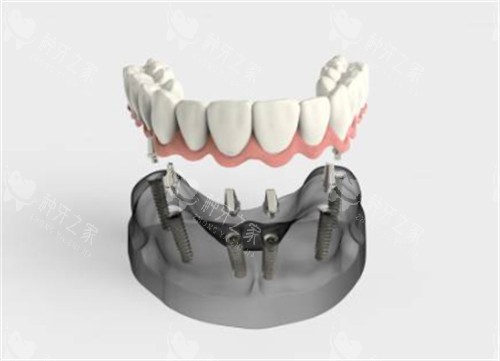 半口种植牙卡通图示意图