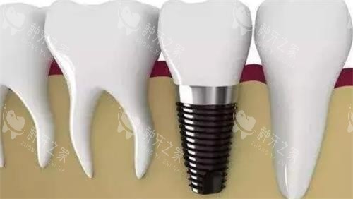 种植牙后***图