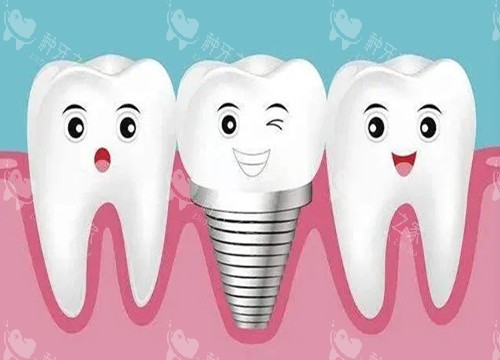 单颗缺牙必看！种植牙修复全攻略与结果解析