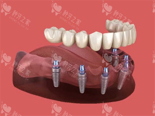 半口种植牙动画示意图展示 半口种植牙动画示意图展示