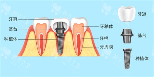 康盛与百康特种植体：价格、材质、适用人群全解析