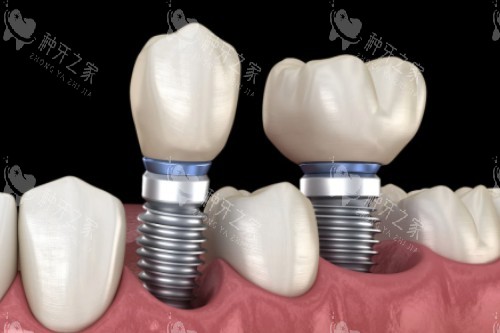 诺贝尔CC种植牙价格揭秘：单颗低至5280元起！