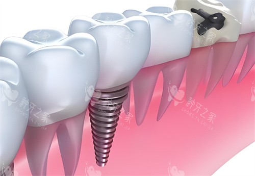 种植牙卡通展示