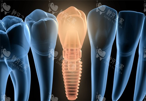德国SKY种植牙深度测评：技术优势与临床结果全解析