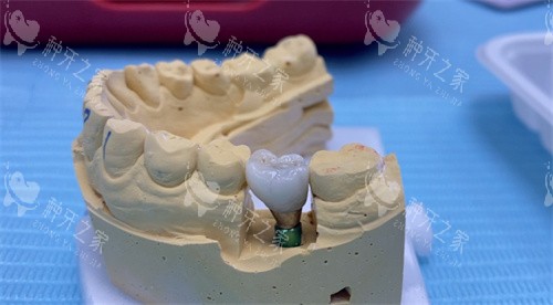 种植牙材料哪种好？看钛合金/氧化锆/纯钛/全瓷差异