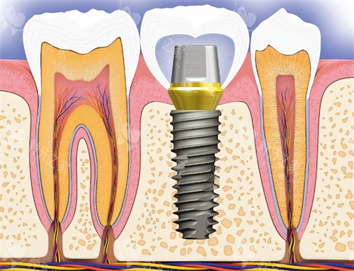 种植牙卡通图片展示