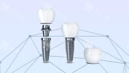 口腔种植牙改善
