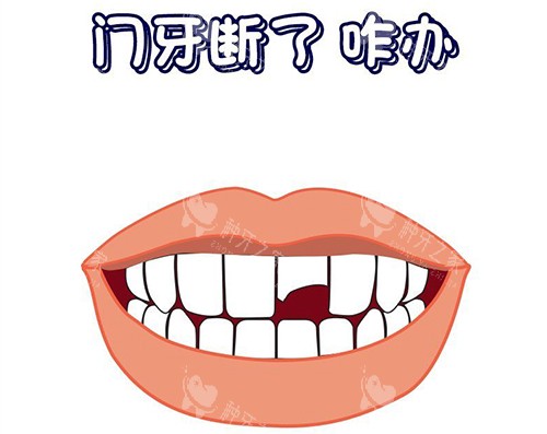 我做门牙种植牙:不疼还自然,美貌回升超惊喜