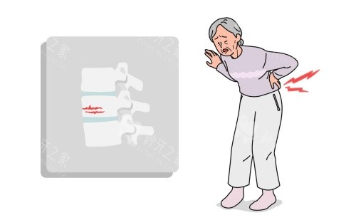 老年人腰骨折示意图