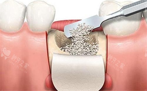 种植牙骨膜多久可以去掉?材质/时间/差异都不小
