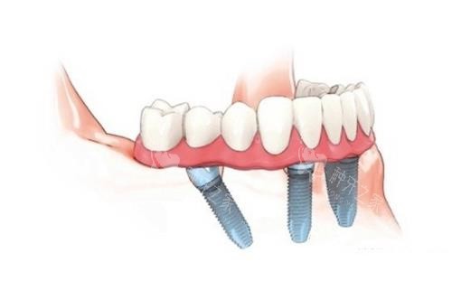 美奥口腔种植牙怎么样？新型技术/服务靠谱/价不贵