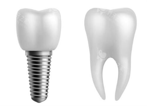 种植牙对比正常牙好在哪