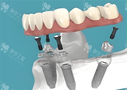 骨粉种植牙与马龙桥种植牙哪个好?看完差异不难选