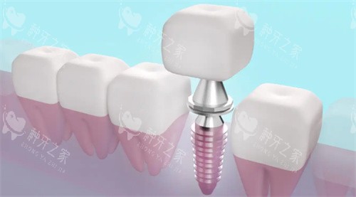 种植牙透视动画展示图