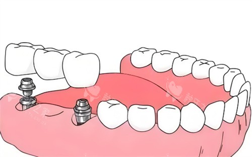 种植牙植骨后如何护理?注意这6点,避免后遗症