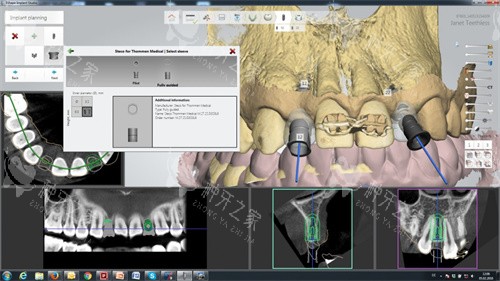瑞士拓美种植体方案设计