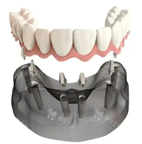 半口牙6个种植体多少钱?2025年更新价格表揭秘