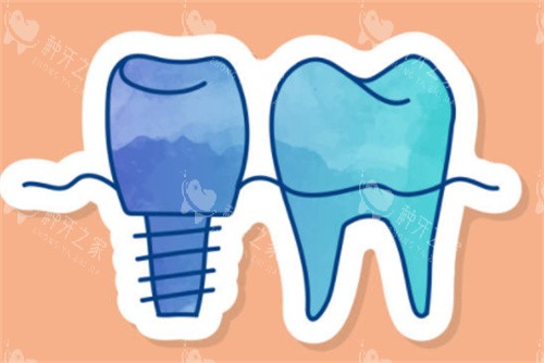 种植牙和正常牙齿