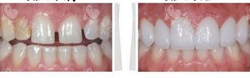 牙齿贴面前后示意图