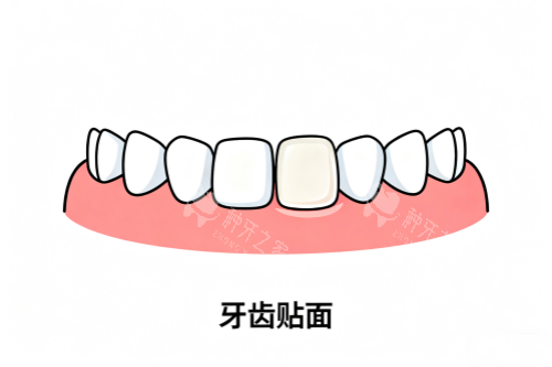 牙齿贴面卡通展示图