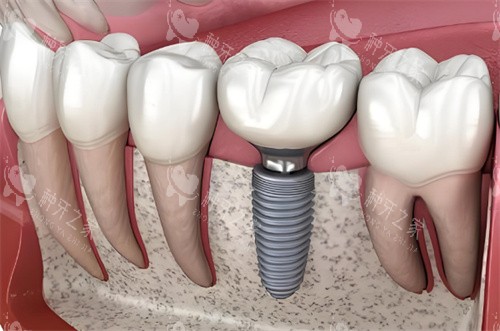 种植牙动画示图