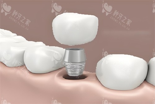 新余现代口腔种植牙这么多优势，技术与服务双优太牛啦