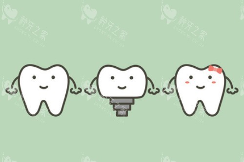 单颗种植牙卡通展示图