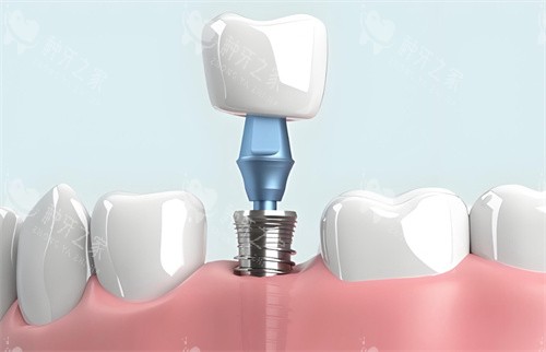 种植牙模型结构图片
