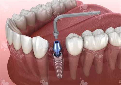 种植牙操作动画图片