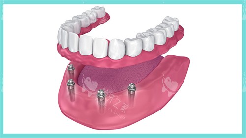 种植牙当天能否种上牙，这里有你想知道的所有答案！