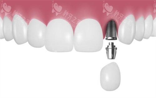 前牙区种植牙示意图