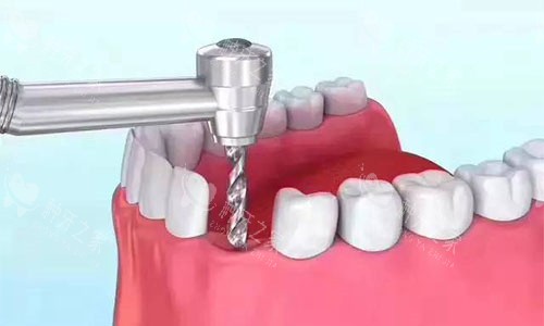 种植牙准备种植窝