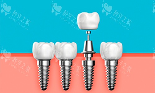 种植牙展示图 种植牙展示图