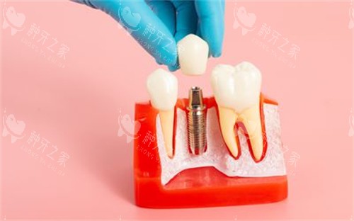 种植牙模型展示图 种植牙模型展示图