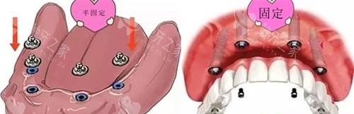 半口半固定种植牙