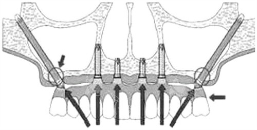 穿颧穿翼种植牙示意图