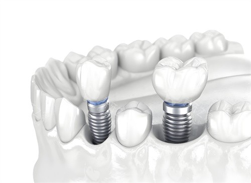 种植牙图片模型