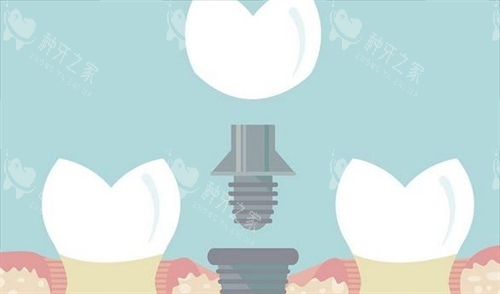 组成种植牙的三部分动画展示